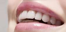 Teeth whitening Brisbane South side