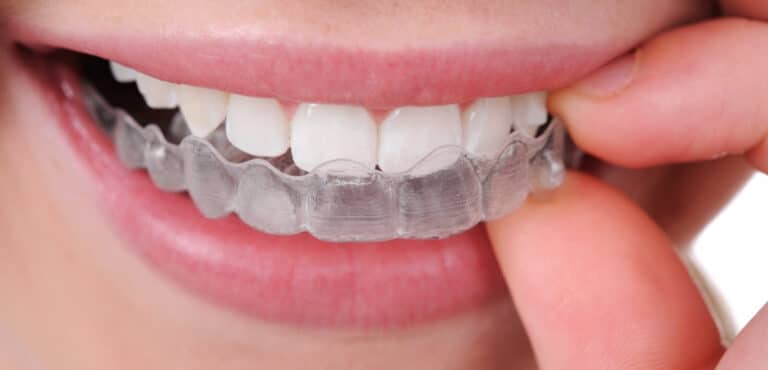 Clear Aligner Therapy in Brisbane