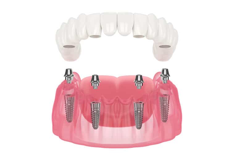 AO4 Dental Implants in Brisbane