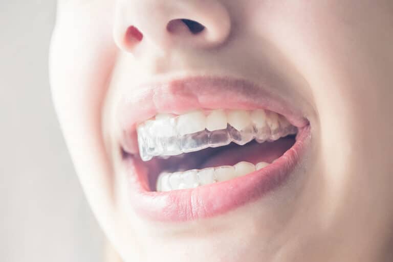 Invisalign in Brisbane