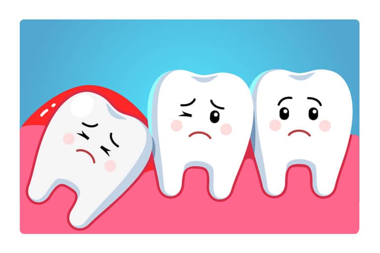 Pericoronitis in Brisbane