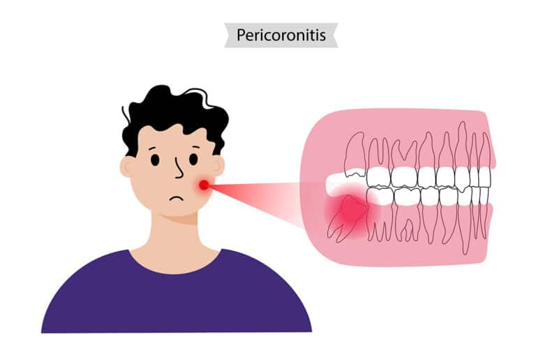 Pericoronitis in Brisbane