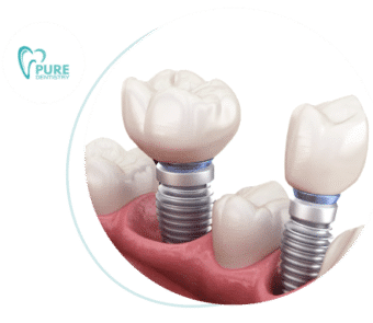 Dental implants Brisbane Queensland.